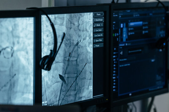 X-ray screens with diagnostic catheters inside heart during electrophysiology procedure and cardiac mapping, medical imaging in hospital