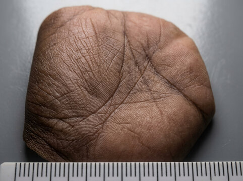 Close Up Of Human Palm Lines And Texture With Measurement Scale