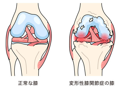 膝関節のしくみ　正常な膝と変形性膝関節症の膝