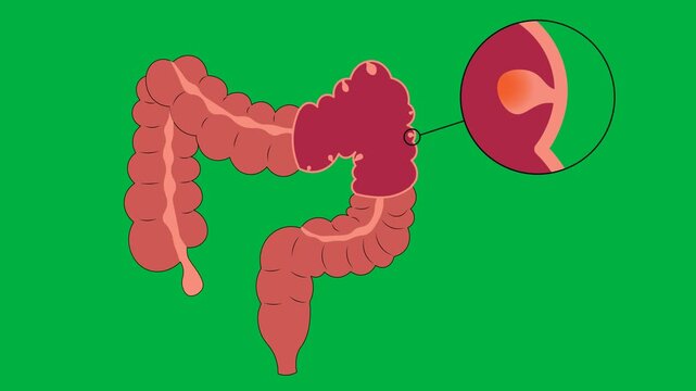 Medical vector animation displaying human large intestine anatomy with a magnified view of an adenomatous growth on the intestinal lining, highlighting bowel polyps, colorectal adenocarcinoma
