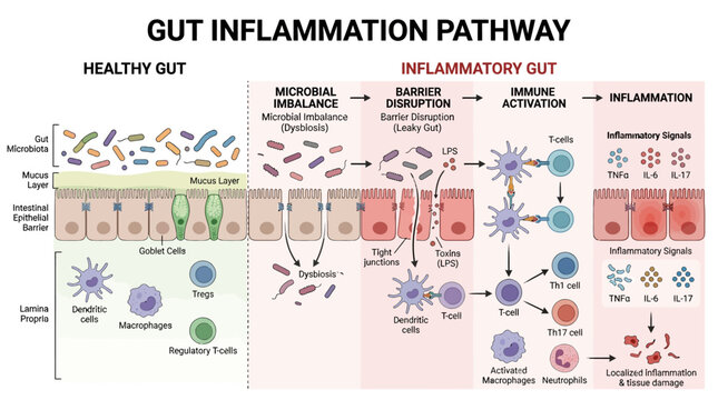 Gut Inflammation Progression From Microbial Imbalance to Immune Activation