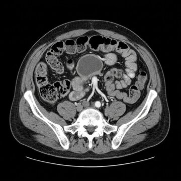 Abdominal Computed Tomography Scan Medical Imaging Diagnosis Health Condition