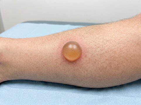Tense Cutaneous Blister on the Lower Leg &mdash; Clinical Dermatology Representation