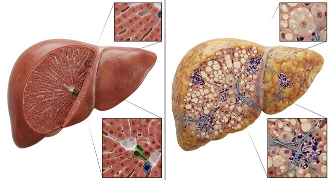 Healthy vs Fatty Liver &ndash; Fatty Liver Medical Pathology Illustration 2