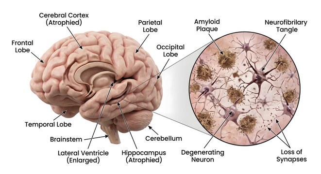 human brain anatomy medical diagram showing alzheimers disease pathology with amyloid plaques neurofibrillary tangles degenerating neurons and brain atrophy on white background for science education