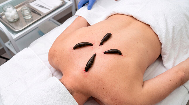 Sharp diagonal top view of medicinal leeches applied to shoulder trigger points for therapy