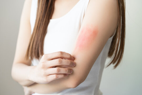 Dermatology asian young woman, girl allergy, allergic reaction from atopic, insect bites on her arm, hand in scratching itchy, itch red spot or rash of skin. Healthcare, treatment of beauty.
