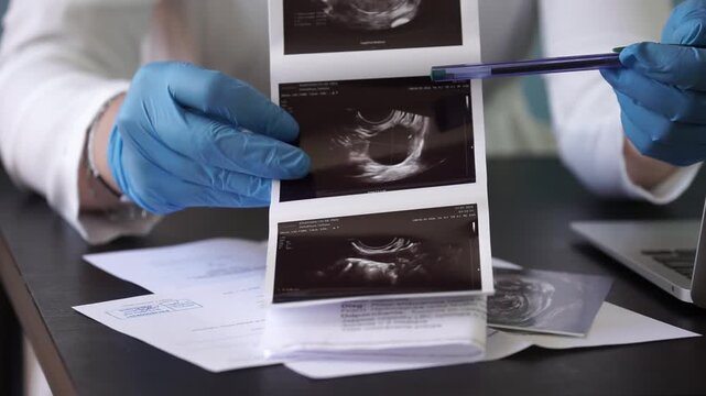 doctor holding ultrasound photo with blue gloves and pointing with pen in medical office closeup, concept of obstetrician, medical consultation, pregnancy checkup