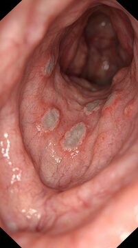 Bacterial pathogen invasion: Syphilis diagnosis, Treponema Pallidum, endoscopic view, mucosal ulcer, detect infection, examine rectum, medical scope, pathology identification.