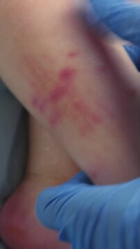 Doctor hands examining infant leg. Little Kid allergy. Closeup. Child scratches a red rash. Nurse applies a special cream to atopic skin. Dermatitis, diathesis, irritation on the baby body. Pruritus