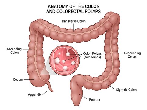 Medical anatomy diagram showing human colon and colorectal polyps