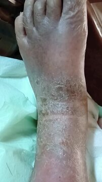Darkened and Thickened Skin on Foot Due to Eczema