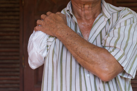Senior man right arm amputation representing disability limb loss physical challenges rehabilitation accessibility independence daily life of an amputee