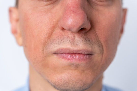 Man with neutral expression showing redness and irritation around nose and cheeks, close up portrait highlighting sensitive skin, dermatology and men's facial skin condition