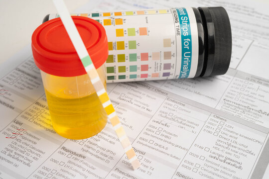 Urinalysis, urine cup with reagent strip pH paper test and comparison chart in laboratory.