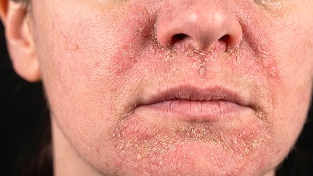 Close-Up View of Facial Seborrheic Dermatitis Showing Red Inflamed Patches and Scaling Around the Nose and Mout