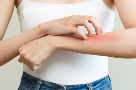 Dermatology, asian young woman reaction from atopic, insect bites on her arm, hand in scratching itchy red spot or rash of skin. Healthcare, treatment of beauty.