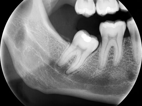 Dental X-ray showing impacted third molar wisdom tooth