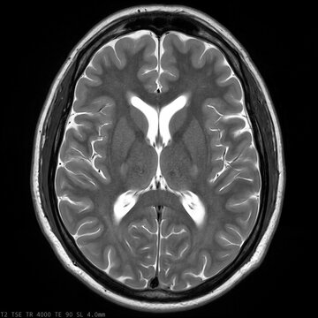 Axial T2 MRI scan of the brain showing cerebral tissue structures