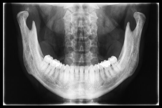 PA mandible X-ray radiograph showing lower jaw bone anatomy