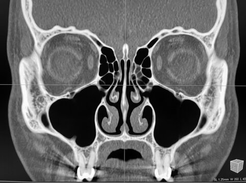 Coronal CT scan of paranasal sinuses showing nasal cavities
