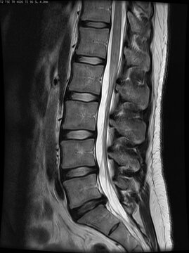 Sagittal lumbar spine MRI showing spinal cord and discs