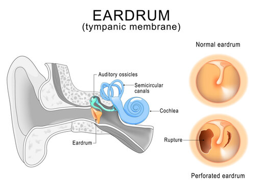 Normal and Perforated eardrum comparison. Close-up of Tympanic membrane rupture. Hearing loss. Middle ear anatomy.