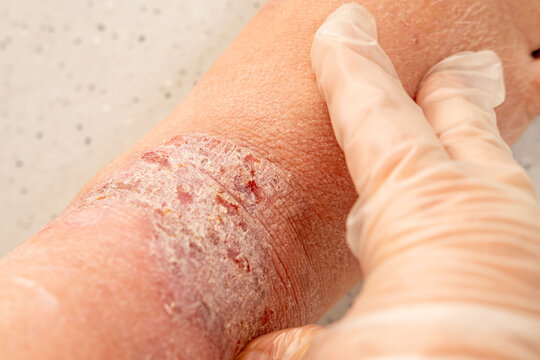 dermatitis allergic reactions, itchy skin on leg, closeup injured female limb damaged reddened skin scratches, wound on painful female leg, chronic dermatological disorder, skin problem, affected area