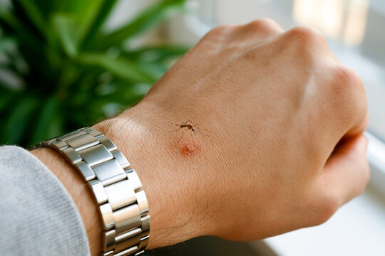 A mosquito sitting next to a red itchy bite mark on a man's hand with a metal watch. Close up of insect skin irritation, allergy reaction and pest control concept.