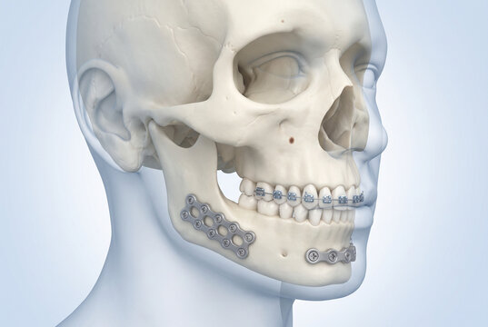 3D medical illustration of mandibular orthognathic surgery showing jaw bone with titanium fixation plates and dental braces, concept for maxillofacial surgery