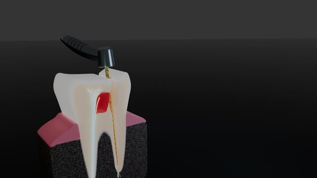 Distal root canal cleaned by endodontic file in tooth cross section