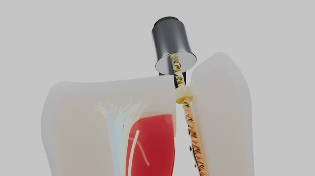 Dental handpiece instrument positioned above molar root canal