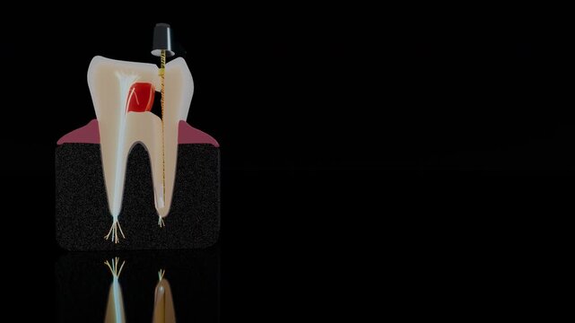 Anatomical tooth cross section with dental file and nerve branches