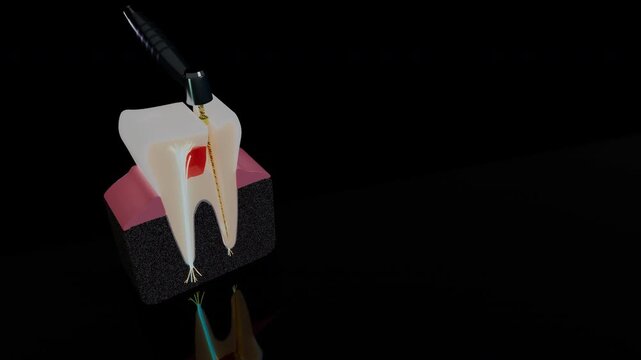 Studio view of molar cross section during root canal procedure