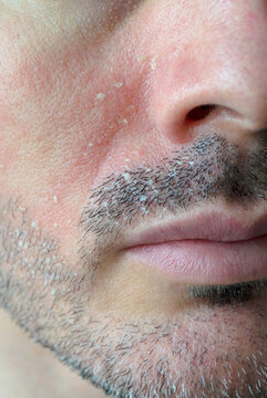 Detalle de rostro con rojez y descamaci&oacute;n de la piel en mejilla, barba y bigote 