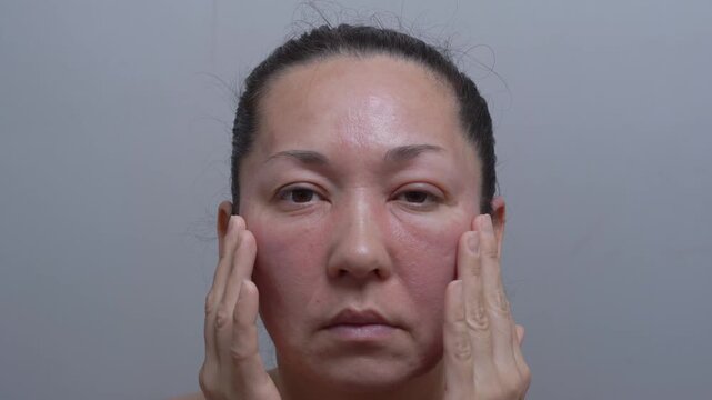 Close-up portrait of a woman with red skin irritation and rosacea symptoms on her face touching cheeks with eyes closed.