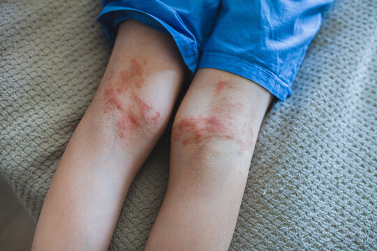 Close-up of child's legs showing red irritated skin rash under knees. Eczema or dermatitis. Childhood skincare, pediatric dermatology, symptoms of allergy or atopic dermatitis. 