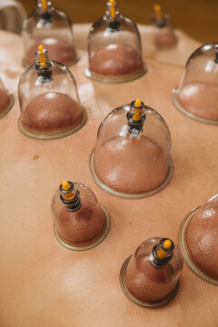 close-up of multiple suction cups on bare back during wet cupping, raised red skin and glossy reflections glow