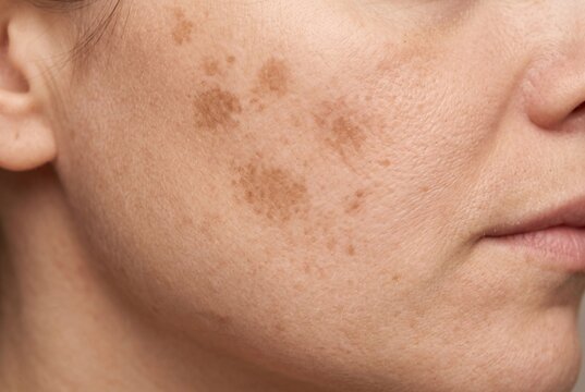 Close-up view of woman cheek with post-inflammatory hyperpigmentation and skin dark spots after healed acne