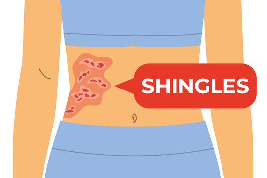 abdomen with a characteristic rash and a speech bubble with Shingles word, herpes zoster, skin symptoms, infection and medical awareness - vector illustration