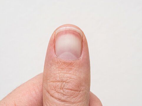 Terry's nail with white nail bed and distal pink-brown band
