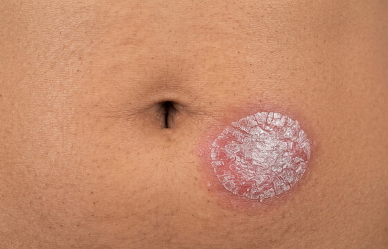 Close up of a large scaly ringworm tinea corporis plaque on abdomen skin