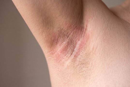 Macro photograph of human axilla skin fold showing mild intertrigo irritation with localized redness and skin friction