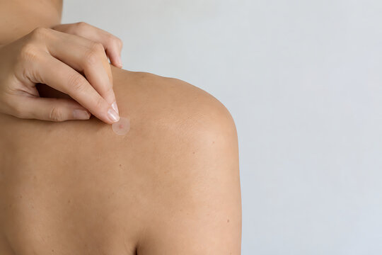 Applying acne patch on upper back skin
