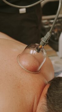 hand holds transparent cupping cup on bare upper back, suction forms raised skin dome with mild redness softly