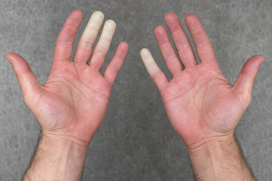 Clinical manifestation of Raynaud's syndrome: vasospasm and digital ischemia of the fingers