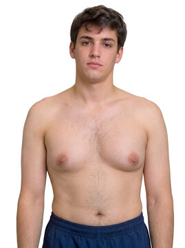 Clinical diagnosis of Klinefelter syndrome: gynecomastia and 47,XXY male phenotype