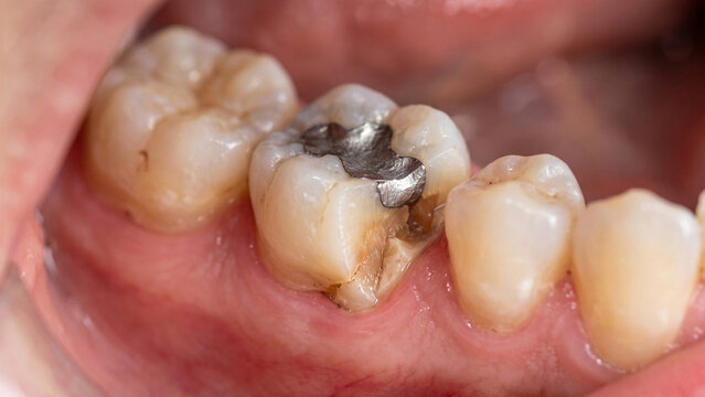 Molar tooth featuring a metallic silver amalgam filling nestled between natural off-white teeth with smooth glossy enamel surfaces.