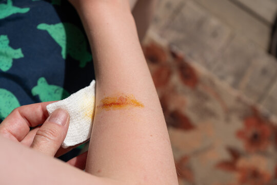 Parent cleaning abrasion on child's arm during home first aid