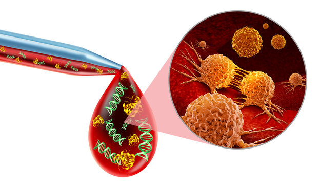Early Detection of Multiple Cancers and Multi cancer early detection or MCED as a liquid biopsy or cancer screening as early tumor detection